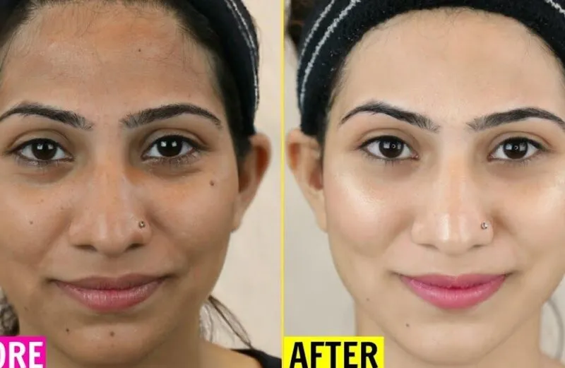25038 chemical peel