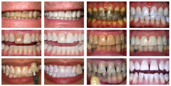 /img/25041-fluoride-treatments.webp