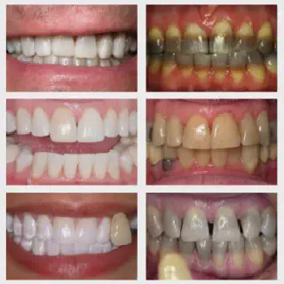 /img/25041-fluoride-treatments.webp