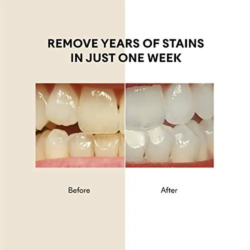 25043 teeth before after whitening