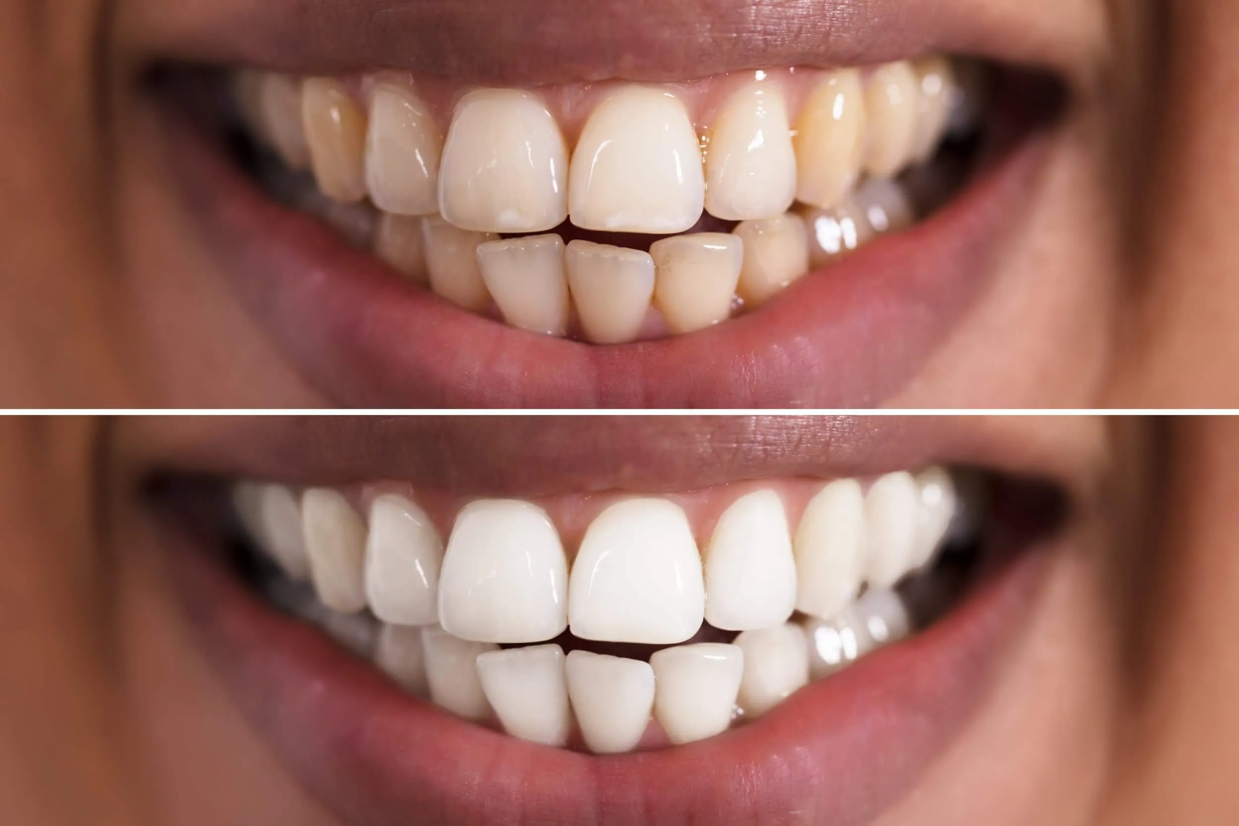 25050 mobile teeth whitening option1