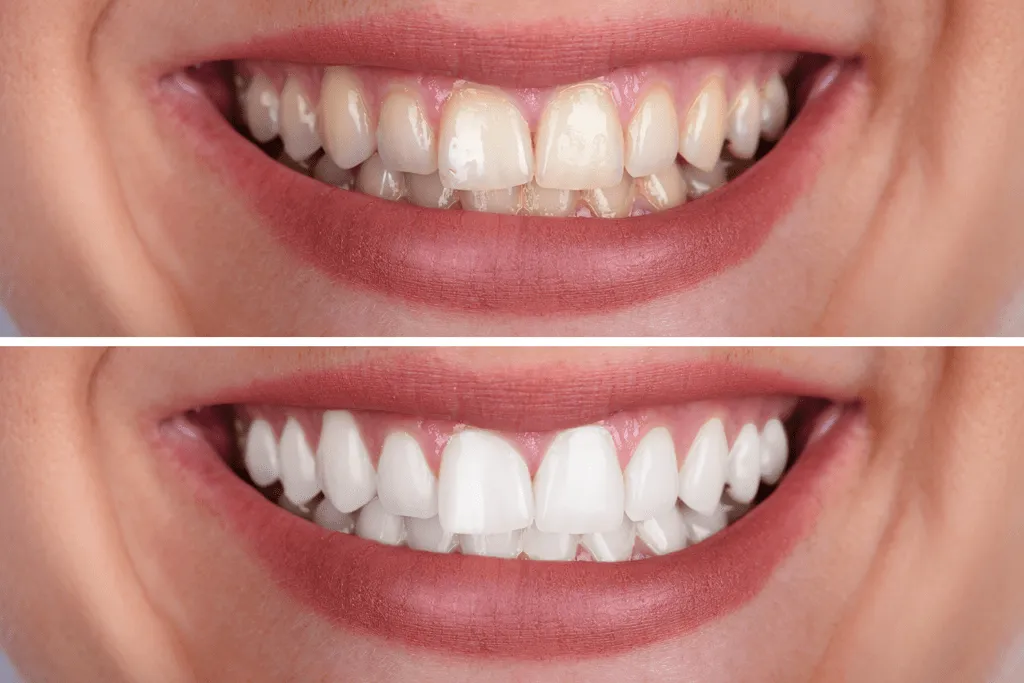 25053 teeth whitening clear lake tx before after