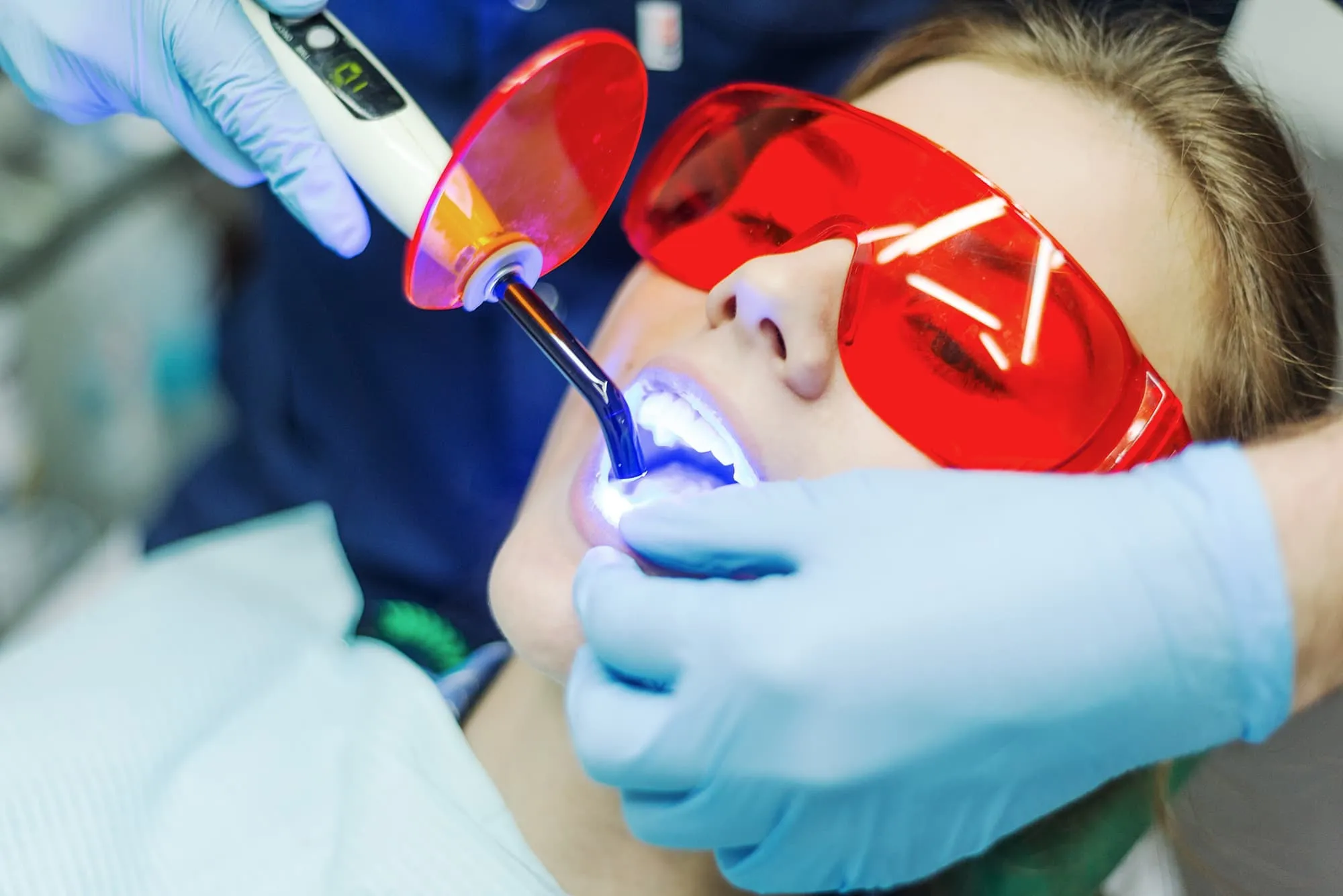 25053 teeth whitening clear lake tx custom trays