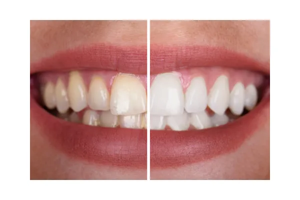 25053 teeth whitening clear lake tx oral hygiene