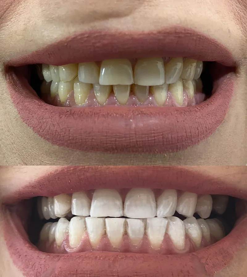 25053 teeth whitening clear lake tx whitening strips