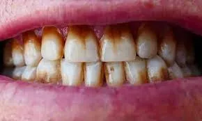 25056 at home teeth whitening kits