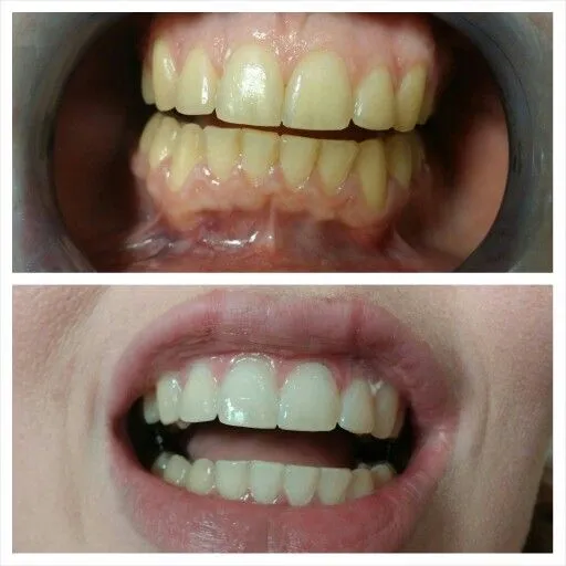 25056 maintaining white smile tips