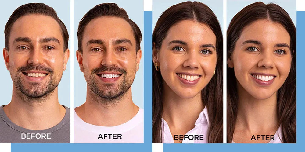 25056 professional teeth whitening nyc