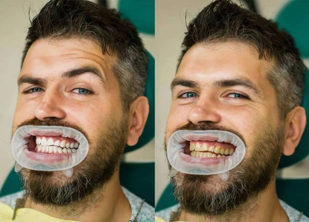 25056 upper east side teeth whitening before after