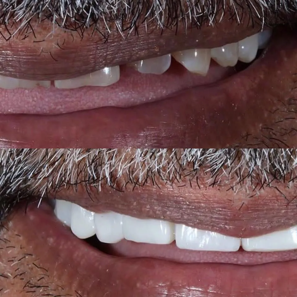 25056 upper east side teeth whitening cost
