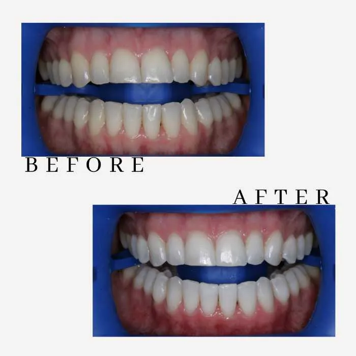 25060 professional teeth whitening