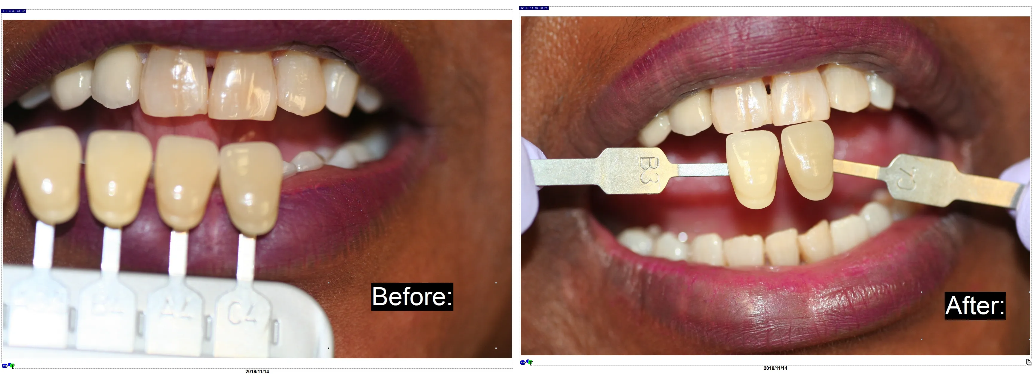 25066 office whitening results