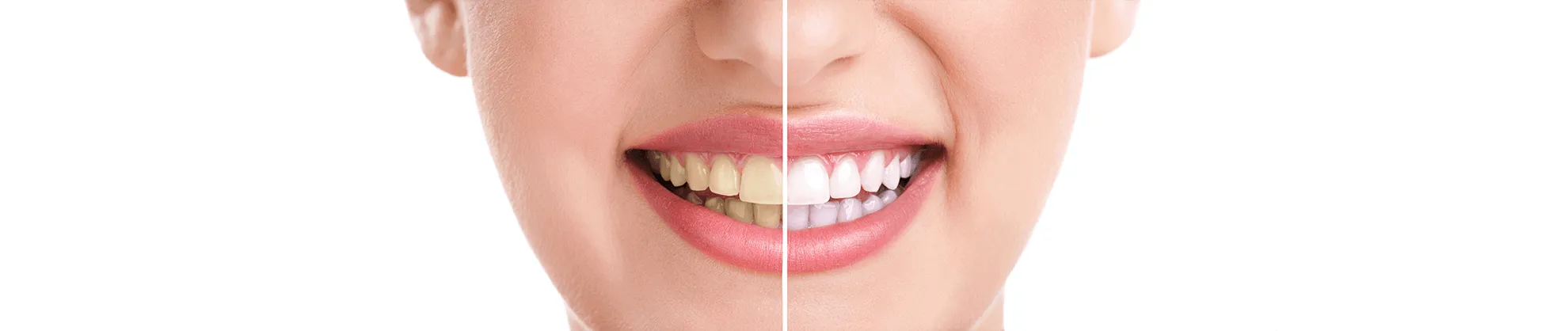 25068 over the counter teeth whitening