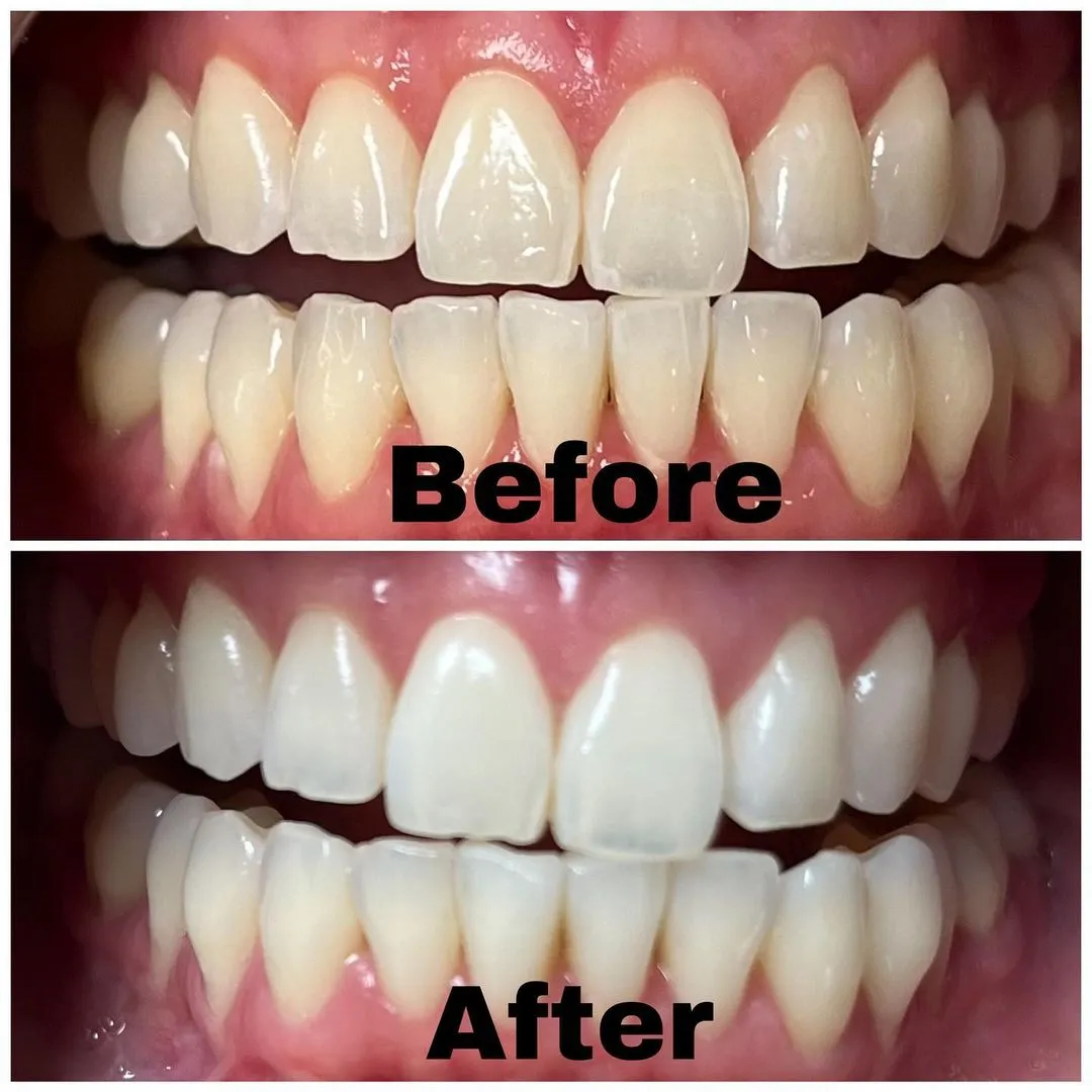 /img/25068-teeth-whitening-smile.webp