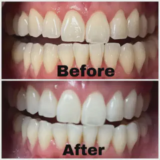 /img/25068-teeth-whitening-smile.webp