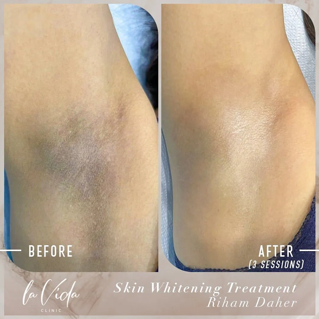 25070 microdermabrasion skin