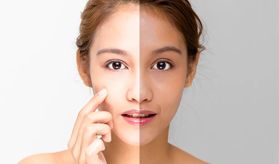 25070 skin whitening treatment