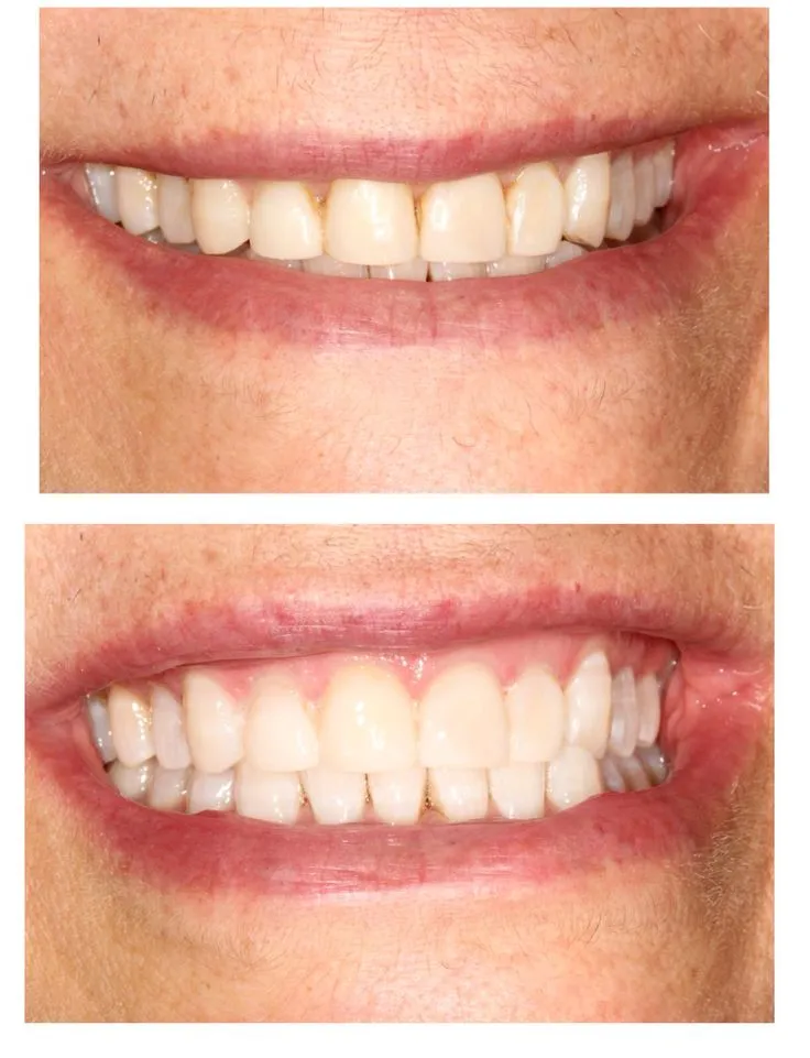 25073 teeth whitening checkups
