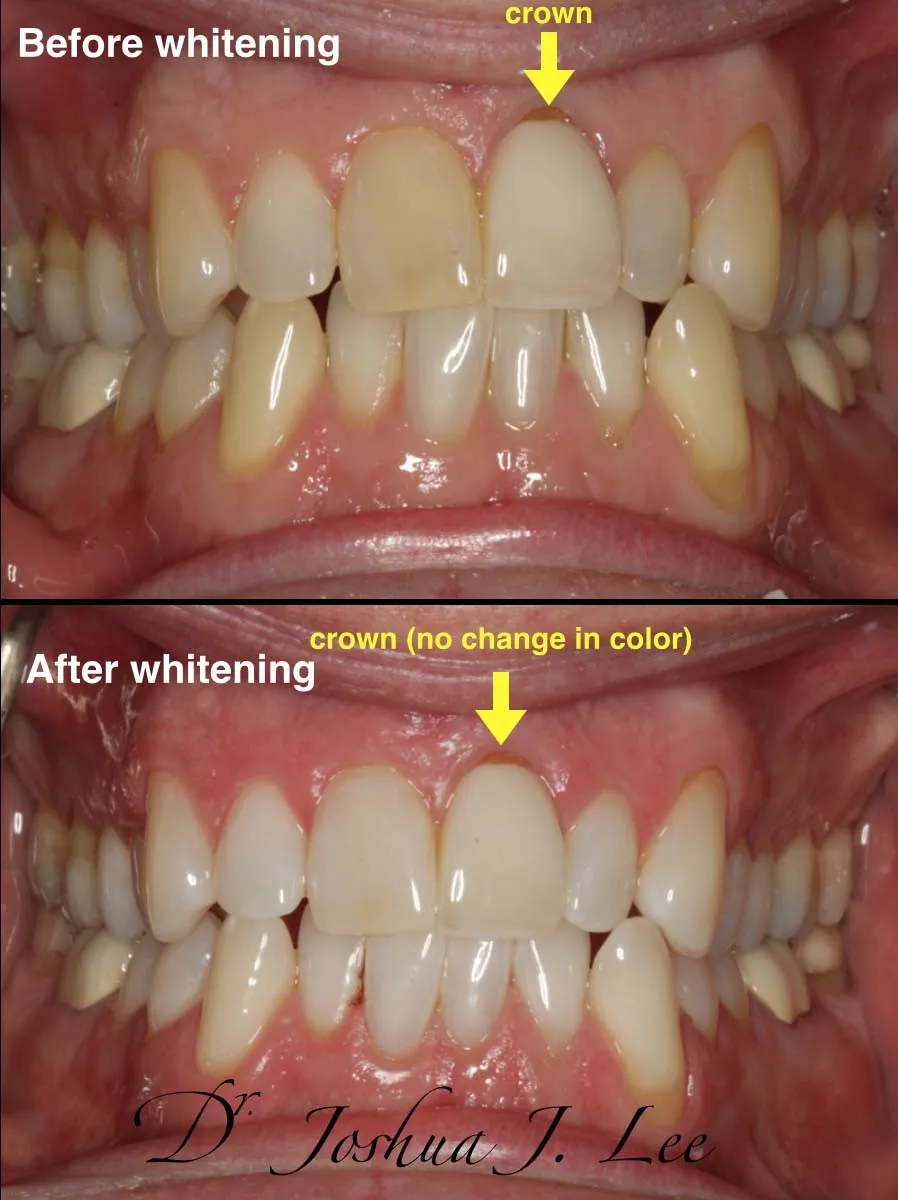 25073 zoom whitening maintenance