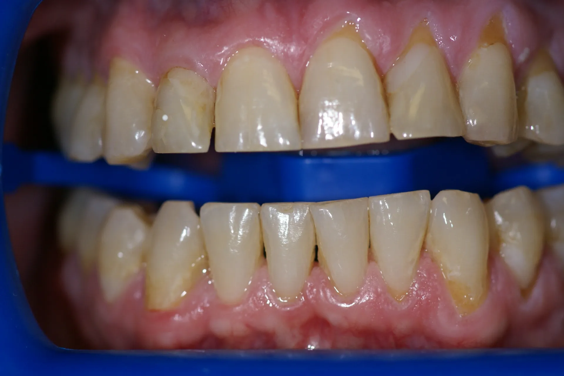 /img/25073-zoom-whitening-smile.webp