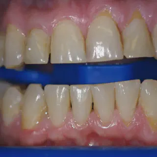 /img/25073-zoom-whitening-smile.webp