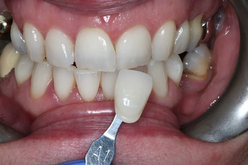 /img/25078-albany-dentist-teeth-whitening.webp