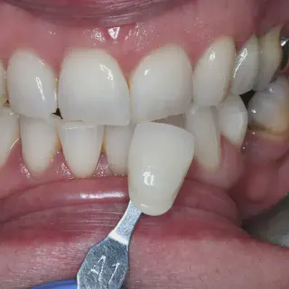 /img/25078-albany-dentist-teeth-whitening.webp