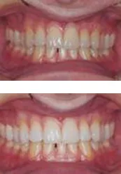 25078 teeth stain removal albany