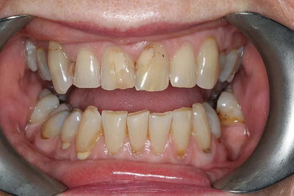 25078 teeth whitening options