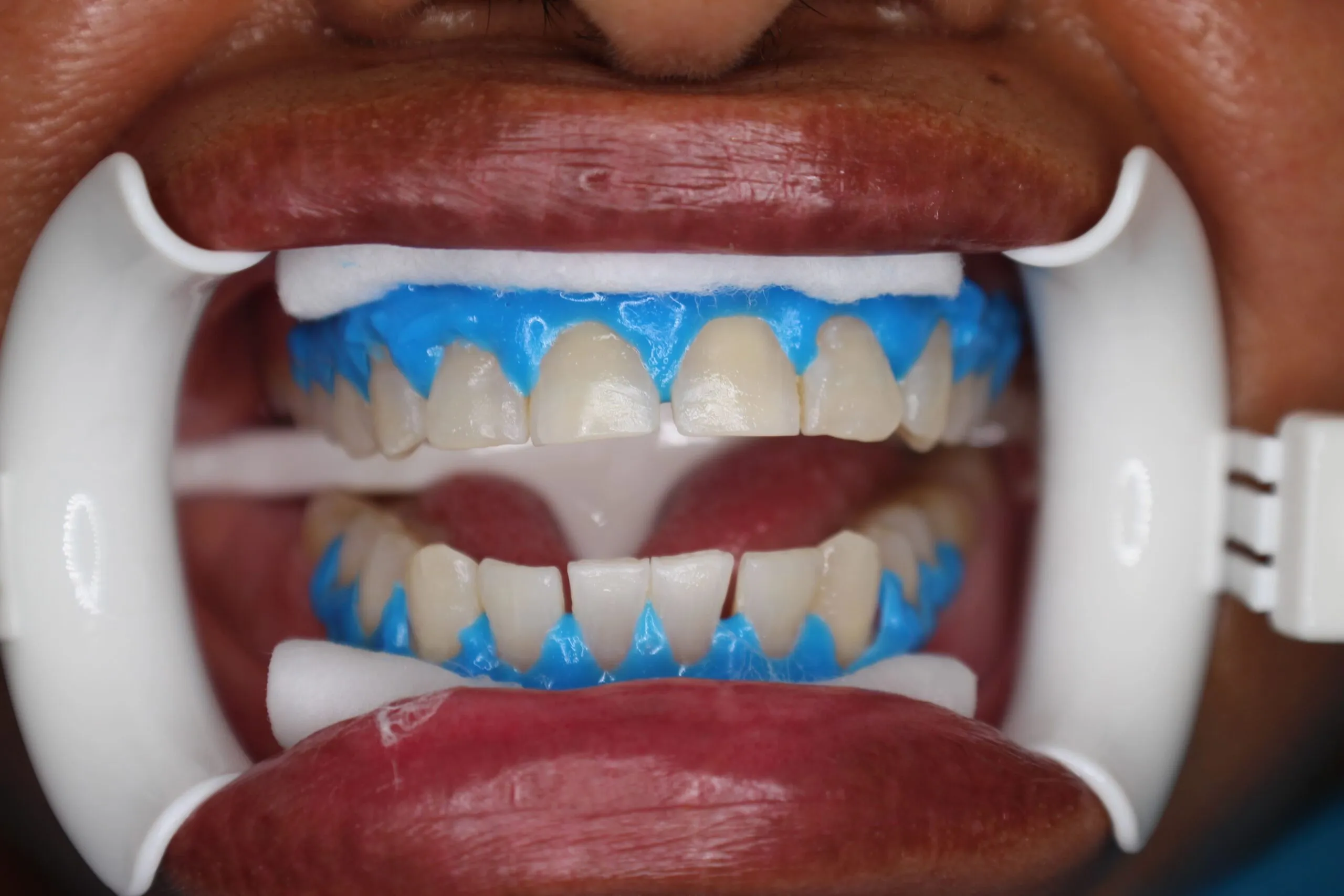 25079 diy teeth whitening
