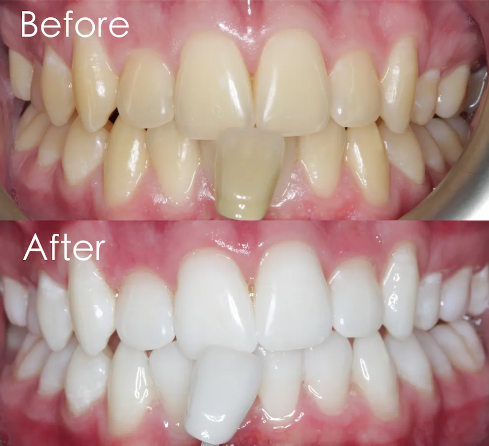 25080 enamel damage