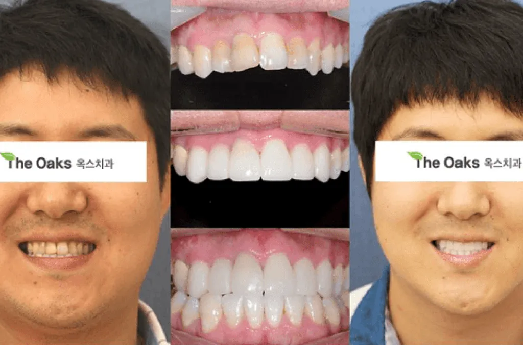 25080 uneven whitening