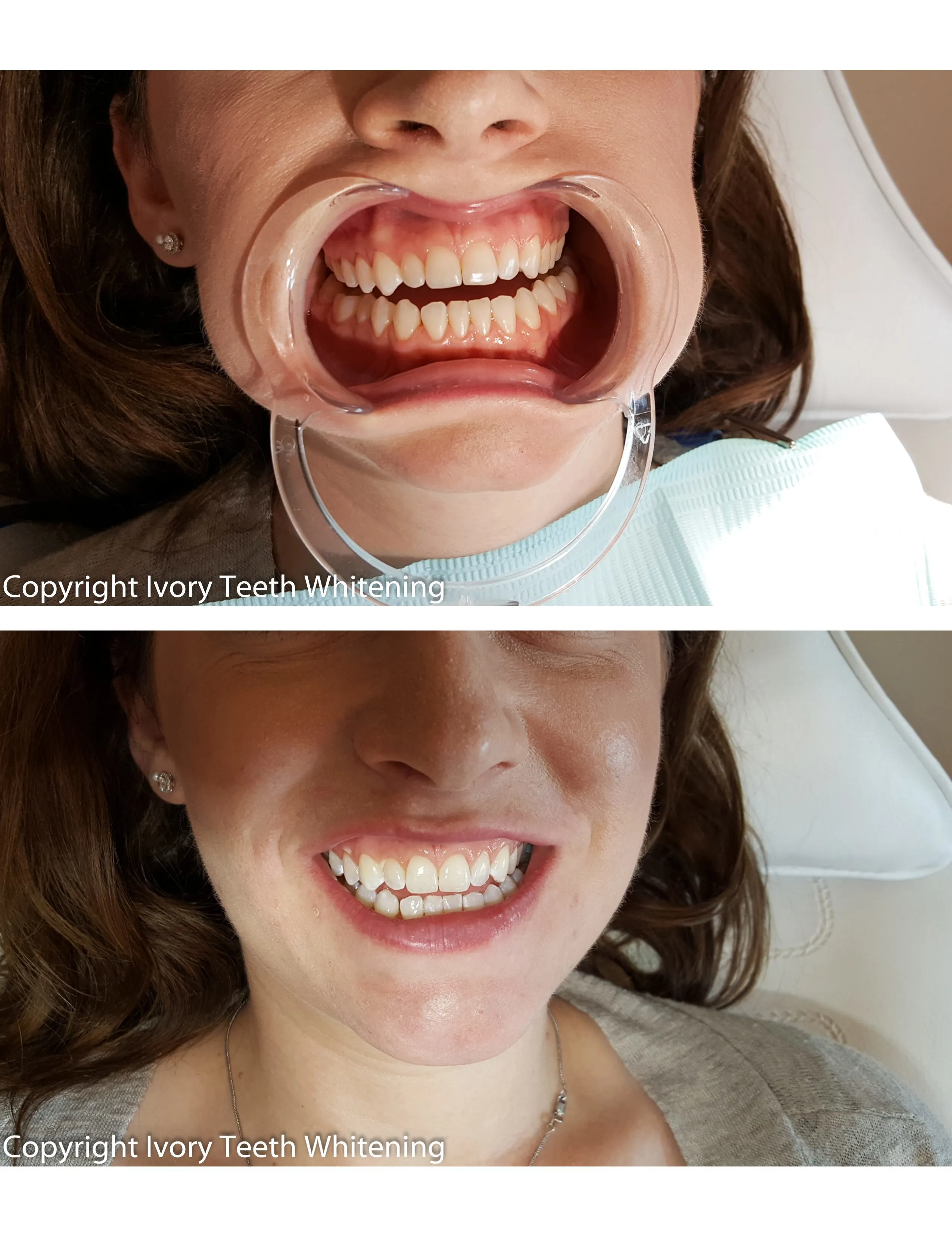 /img/25081-ivory-whitening-checkup.webp