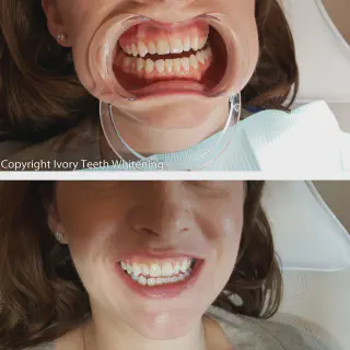 /img/25081-ivory-whitening-checkup.webp