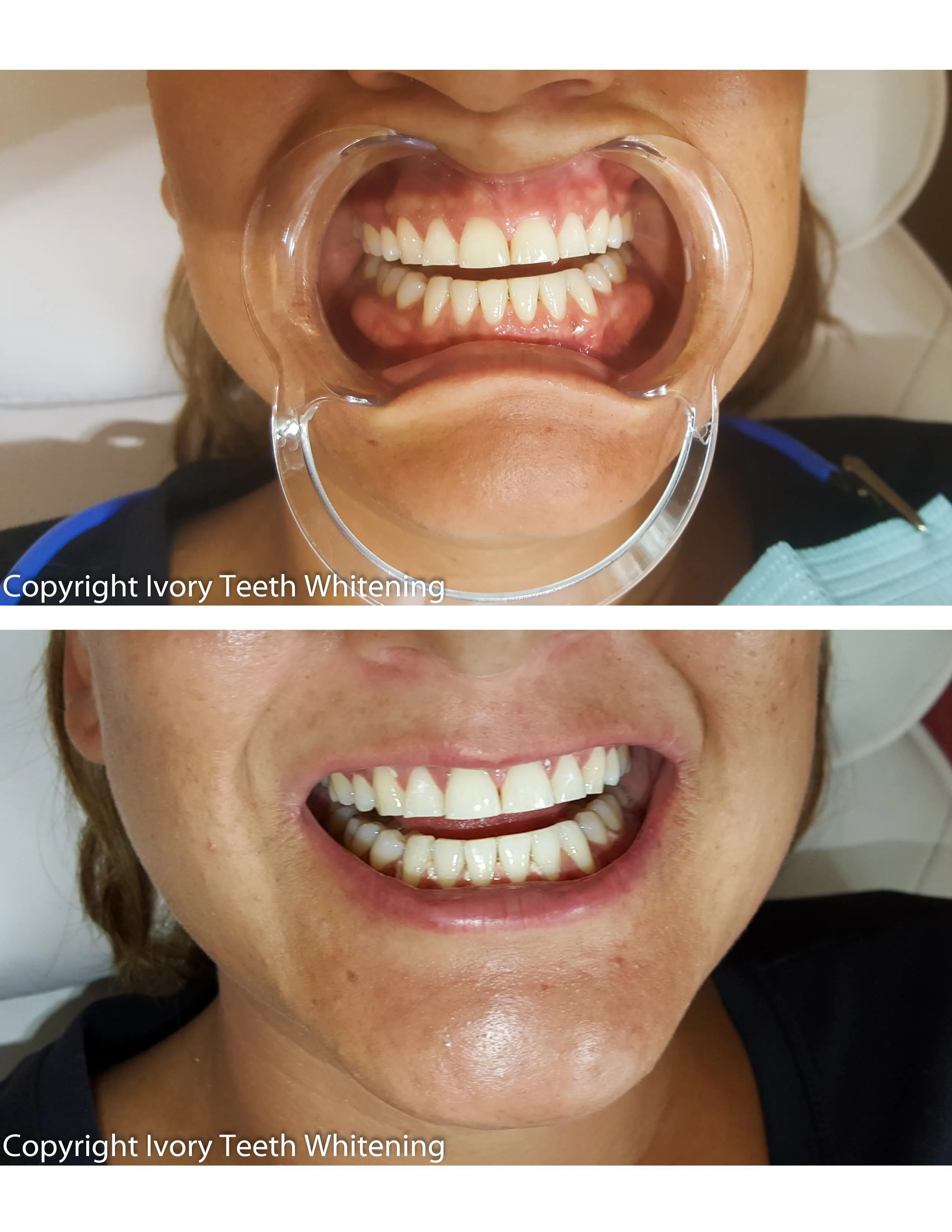 25081 ivory whitening diet