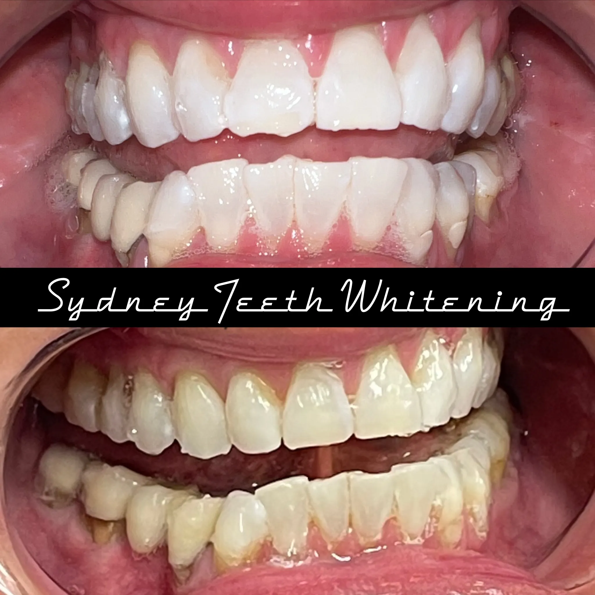 25083 teeth whitening nsw before after