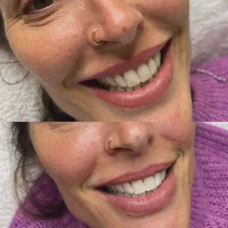 /img/25083-teeth-whitening-nsw-smiling-woman.webp