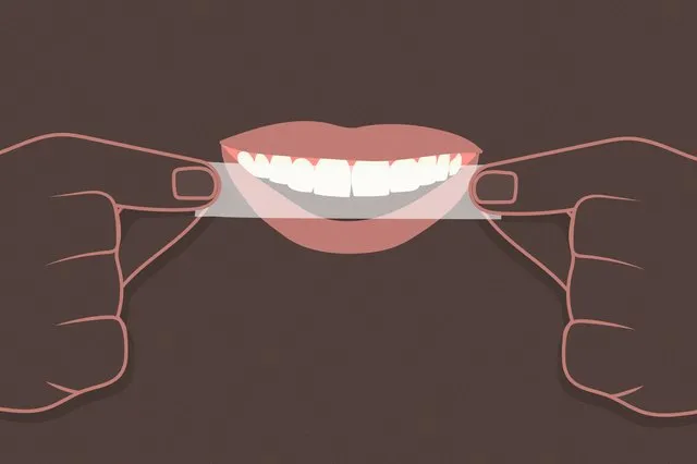 25084 fluoride treatment