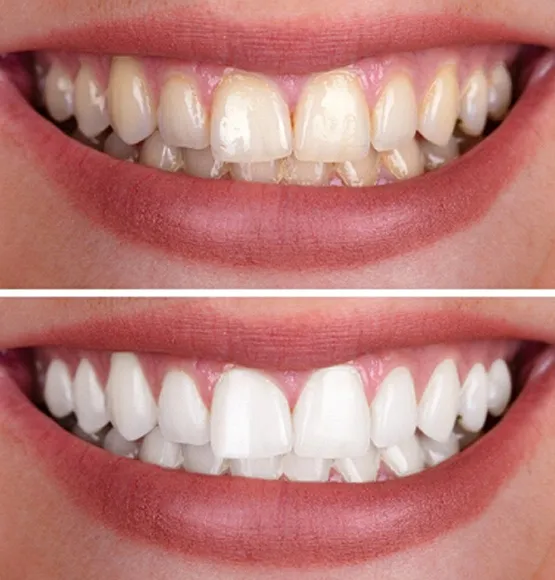 25086 at home teeth whitening kits tucson
