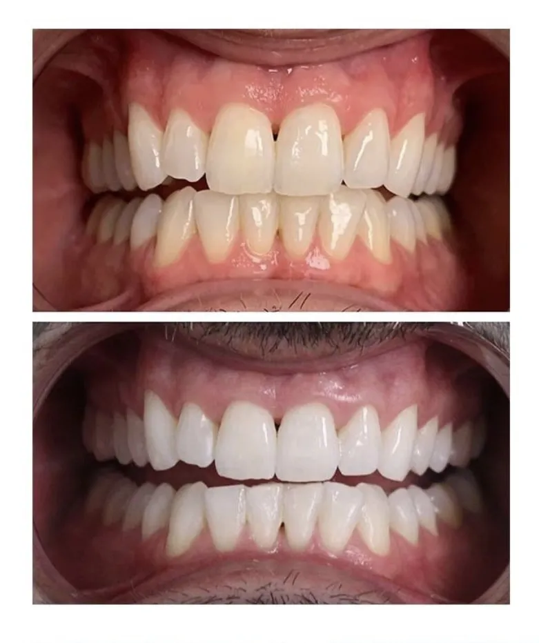 25086 in office teeth whitening tucson