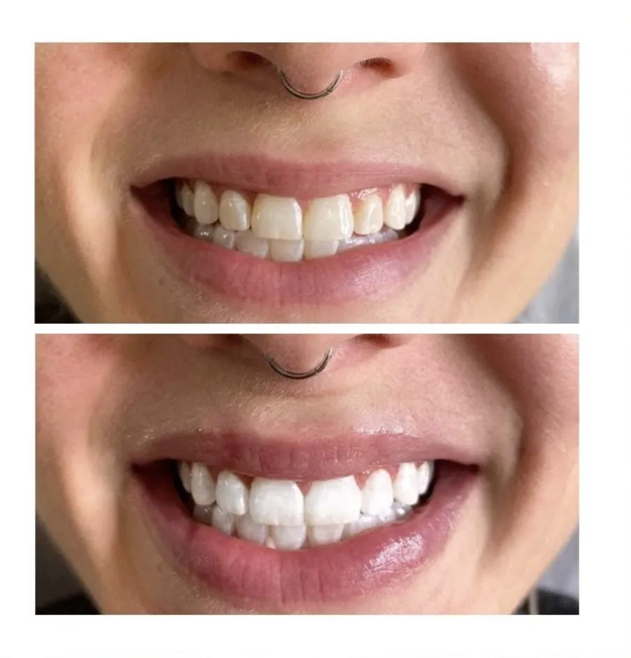 25086 tucson dentist teeth whitening