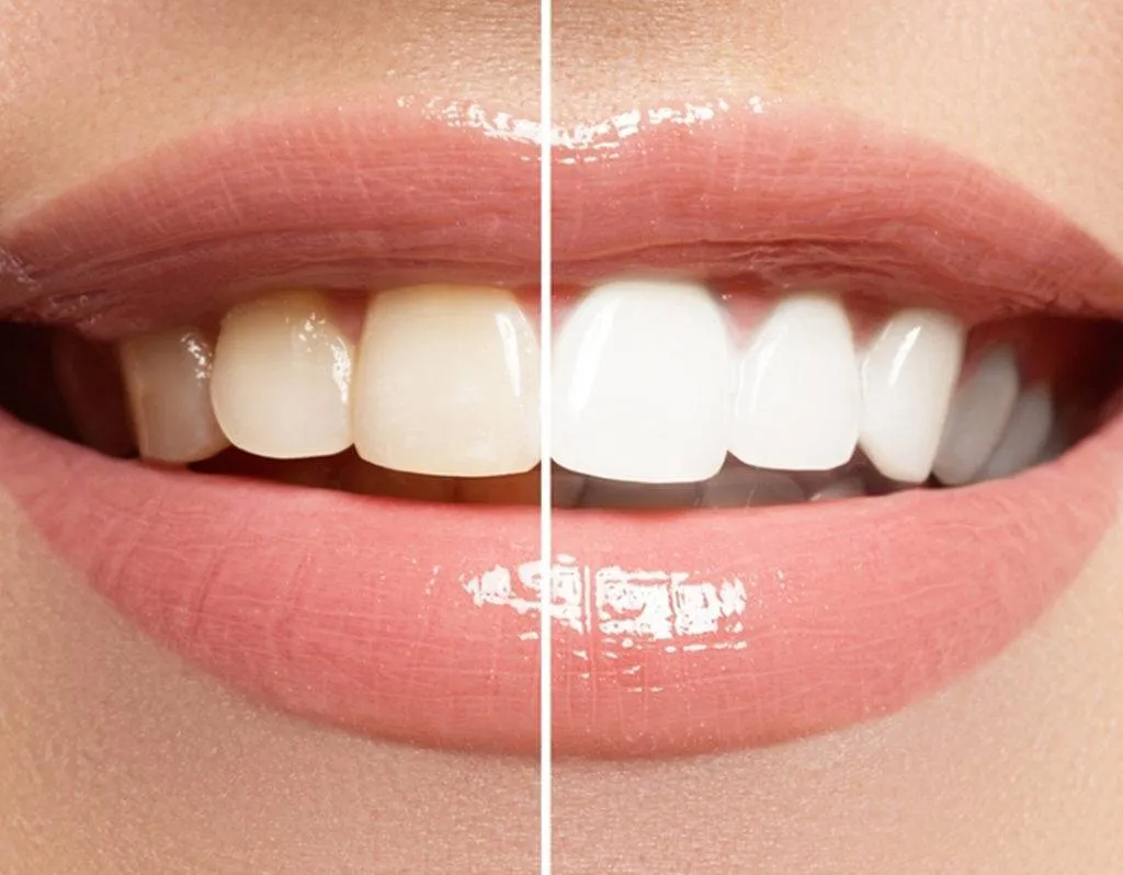 25091 teeth whitening vs bleaching