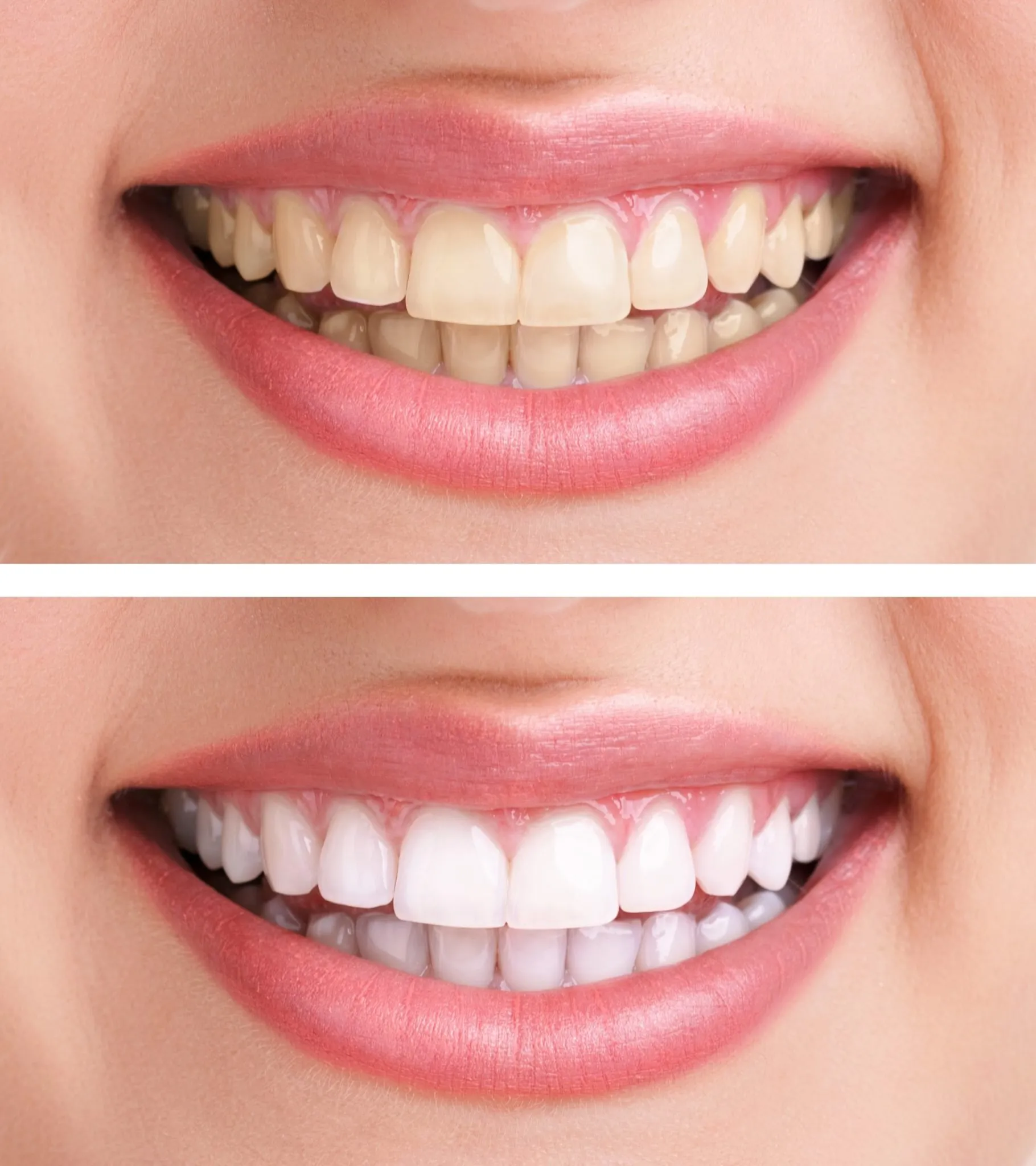 25091 types of teeth whitening