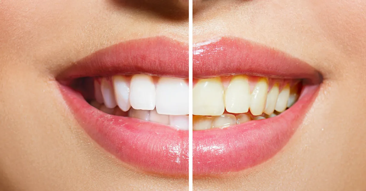 /img/25093-teeth-whitening-aftercare.webp