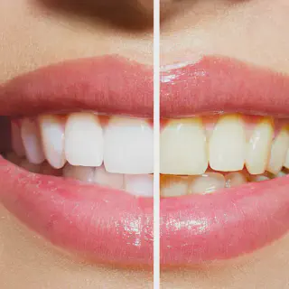/img/25093-teeth-whitening-aftercare.webp