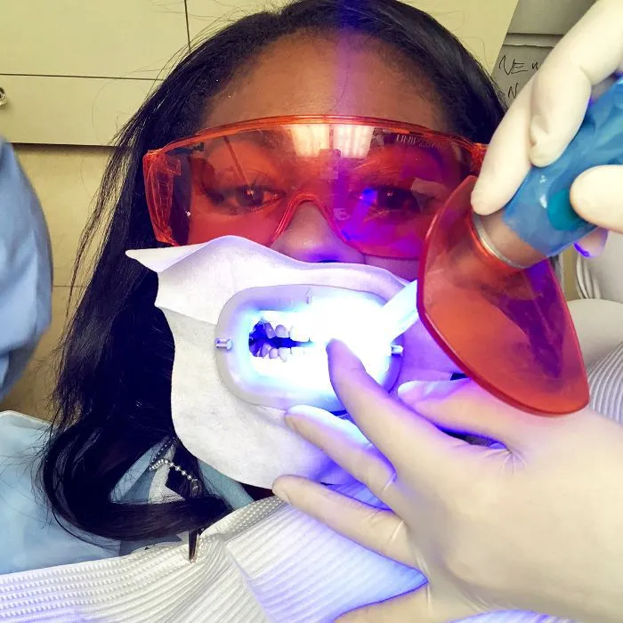 25093 teeth whitening results