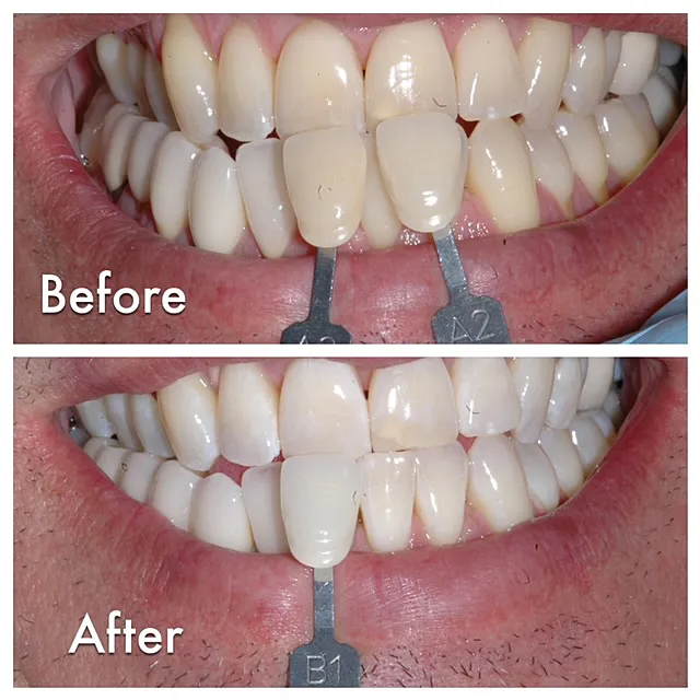 25093 teeth whitening sensitivity