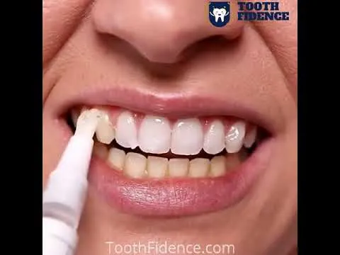 25094 teeth whitening pen before after