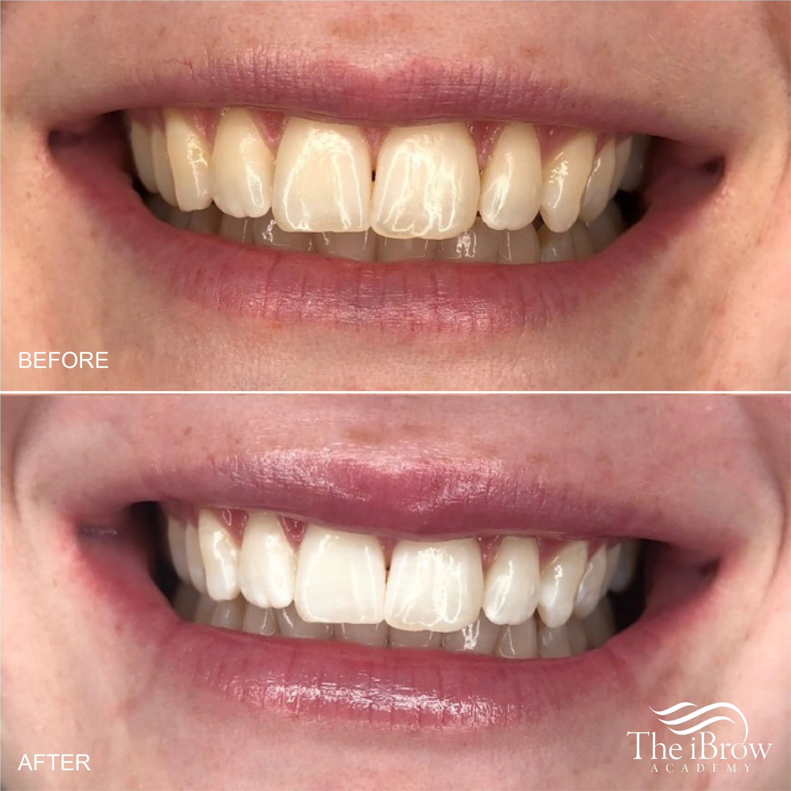 25102 at home teeth whitening