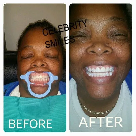 25106 celebrity teeth whitening